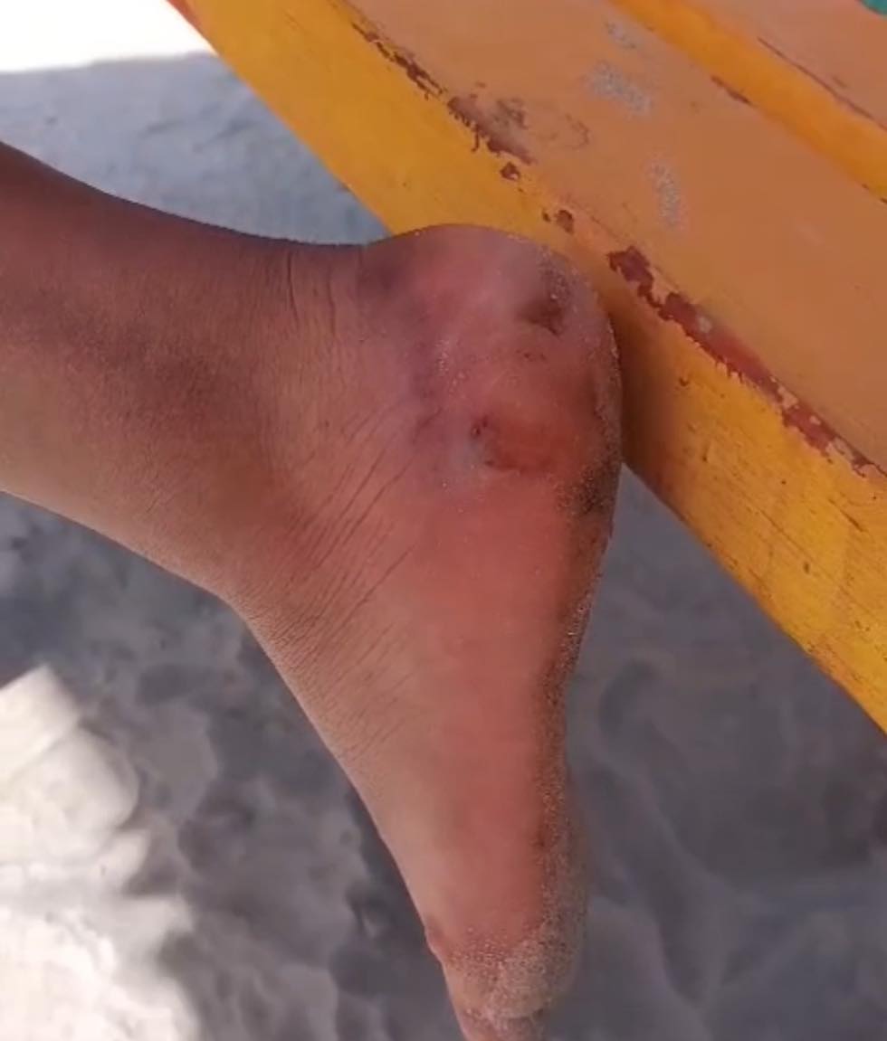 Cruz Roja atendió  a 20 lesionados por picadura de mantarrayas en Playa Bagdad