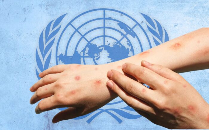 OMS lanza plan estratégico contra el mpox