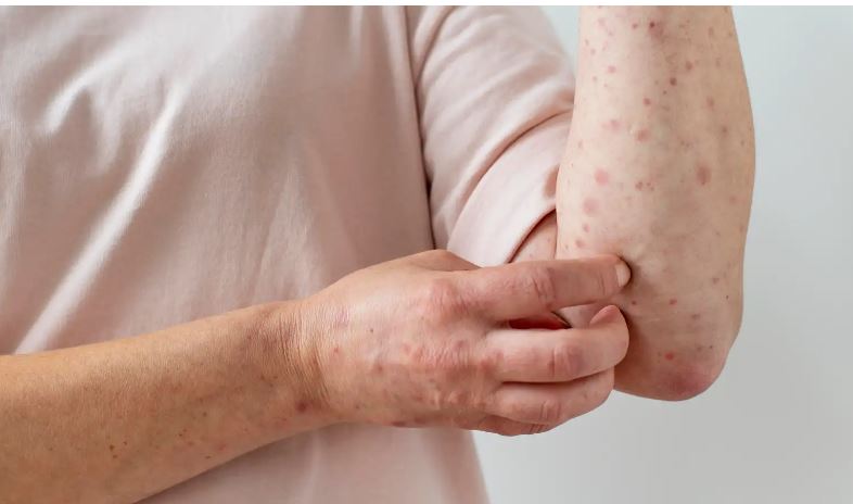 Se agrava brote de sarampión en ciudad de Texas antivacunas