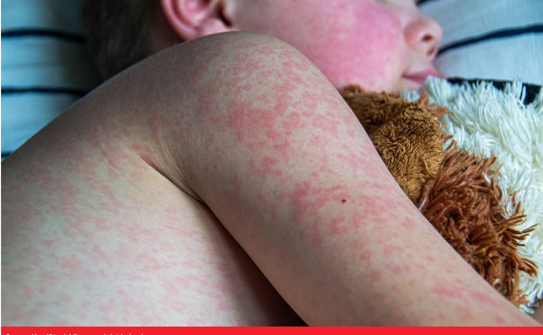 Por Sarampión, emiten aviso epidemiológico