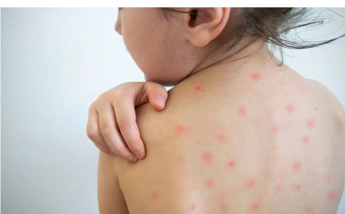 Sarampión en México va en aumento con 421 casos