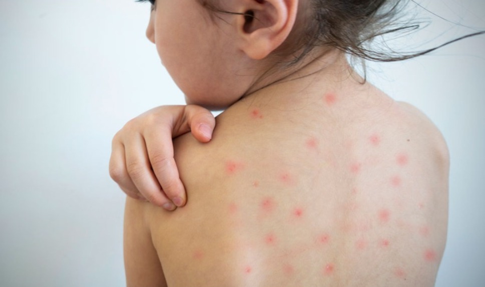 Con nueve casos, Tamaulipas ya es cuarto lugar nacional en contagios de sarampión