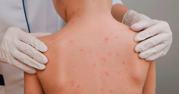 Alertan que México podría perder estatus de país libre de sarampión