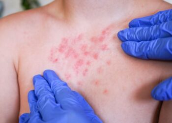 México acumula más de 12 mil contagios de sarampión y 33 fallecimientos