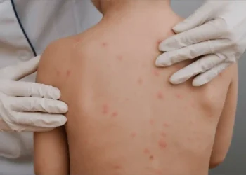 Tamaulipas casi duplica casos de varicela de 2025