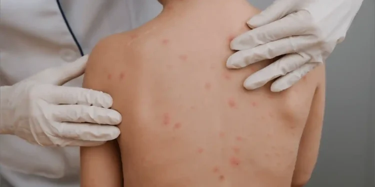 Tamaulipas casi duplica casos de varicela de 2025